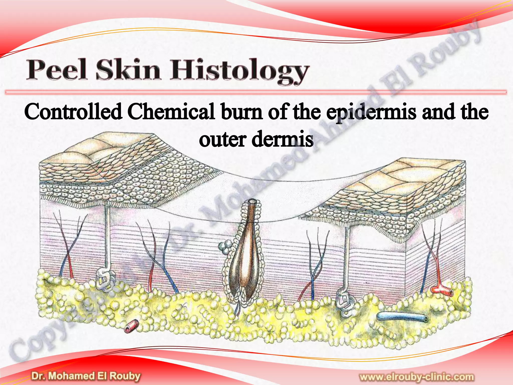 Chemical peel