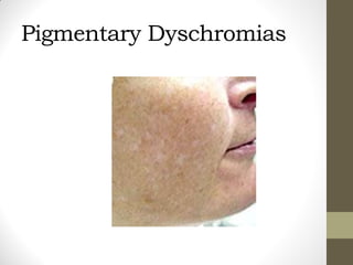 Pigmentary Dyschromias
 