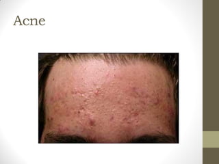 Acne
 