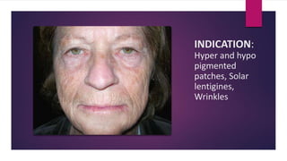 INDICATION:
Hyper and hypo
pigmented
patches, Solar
lentigines,
Wrinkles
 