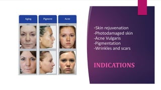 -Skin rejuvenation
-Photodamaged skin
-Acne Vulgaris
-Pigmentation
-Wrinkles and scars
INDICATIONS
 