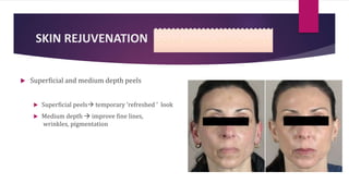 SKIN REJUVENATION
 Superficial and medium depth peels
 Superficial peels temporary ‘refreshed ’ look
 Medium depth  improve fine lines,
wrinkles, pigmentation
 