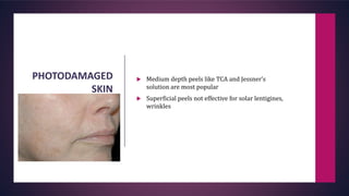 PHOTODAMAGED
SKIN
 Medium depth peels like TCA and Jessner’s
solution are most popular
 Superficial peels not effective for solar lentigines,
wrinkles
 
