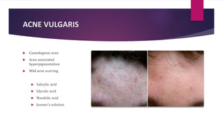 ACNE VULGARIS
 Comedogenic acne
 Acne associated
hyperpigmentation
 Mild acne scarring
 Salicylic acid
 Glycolic acid
 Mandelic acid
 Jessner’s solution
 