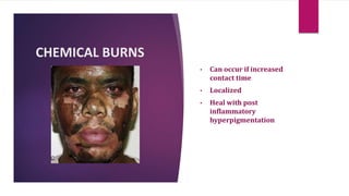 CHEMICAL BURNS
• Can occur if increased
contact time
• Localized
• Heal with post
inflammatory
hyperpigmentation
 