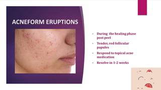 ACNEFORM ERUPTIONS
• During the healing phase
post peel
• Tender, red follicular
papules
• Respond to topical acne
medication
• Resolve in 1-2 weeks
 