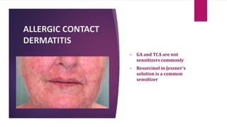 ALLERGIC CONTACT
DERMATITIS
• GA and TCA are not
sensitizers commonly
• Resorcinol in Jessner’s
solution is a common
sensitizer
 