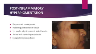 POST-INFLAMMATORY
HYPERPIGMENTATION
 Unprotected sun exposure
 More frequent in skin of colour
 1-4 weeks after treatment; up to 8 weeks
 Prime with topical hydroquinone
 Sun protection/avoidance
 