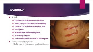 SCARRING
 At risk
 Exaggerated inflammatory response
 History of poor/delayed wound healing
 Tendency of keloid/hypertrophic scar
 Deep peels
 Inadequate time between peels
 Infection post peel
 On oral isotretinoin 6 months before peel
 Focal persistent erythema
Indurated erythematous patches/plaques
 