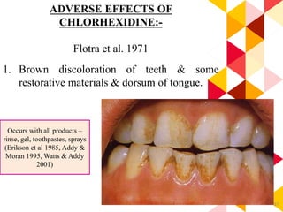 67
ADVERSE EFFECTS OF
CHLORHEXIDINE:-
Flotra et al. 1971
1. Brown discoloration of teeth & some
restorative materials & dorsum of tongue.
Occurs with all products –
rinse, gel, toothpastes, sprays
(Erikson et al 1985, Addy &
Moran 1995, Watts & Addy
2001)
 