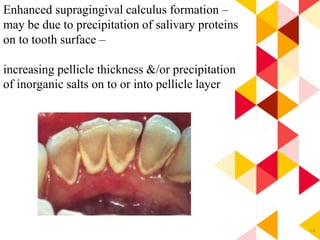 74
Enhanced supragingival calculus formation –
may be due to precipitation of salivary proteins
on to tooth surface –
increasing pellicle thickness &/or precipitation
of inorganic salts on to or into pellicle layer
 