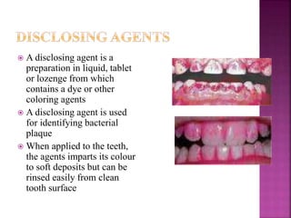 A disclosing agent is a
preparation in liquid, tablet
or lozenge from which
contains a dye or other
coloring agents
 A disclosing agent is used
for identifying bacterial
plaque
 When applied to the teeth,
the agents imparts its colour
to soft deposits but can be
rinsed easily from clean
tooth surface
 