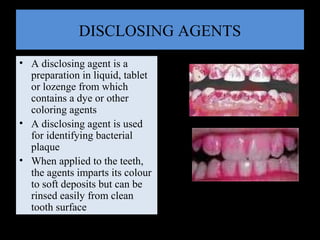DISCLOSING AGENTS
• A disclosing agent is a
preparation in liquid, tablet
or lozenge from which
contains a dye or other
coloring agents
• A disclosing agent is used
for identifying bacterial
plaque
• When applied to the teeth,
the agents imparts its colour
to soft deposits but can be
rinsed easily from clean
tooth surface
 