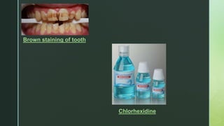 z
Brown staining of tooth
Chlorhexidine
 