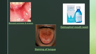 z
Mucosal soreness & erosion
Staining of tongue
DelmopInol mouth wash
 