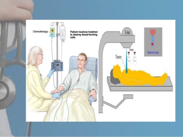 Chemotherapy at different stages of lung cancer