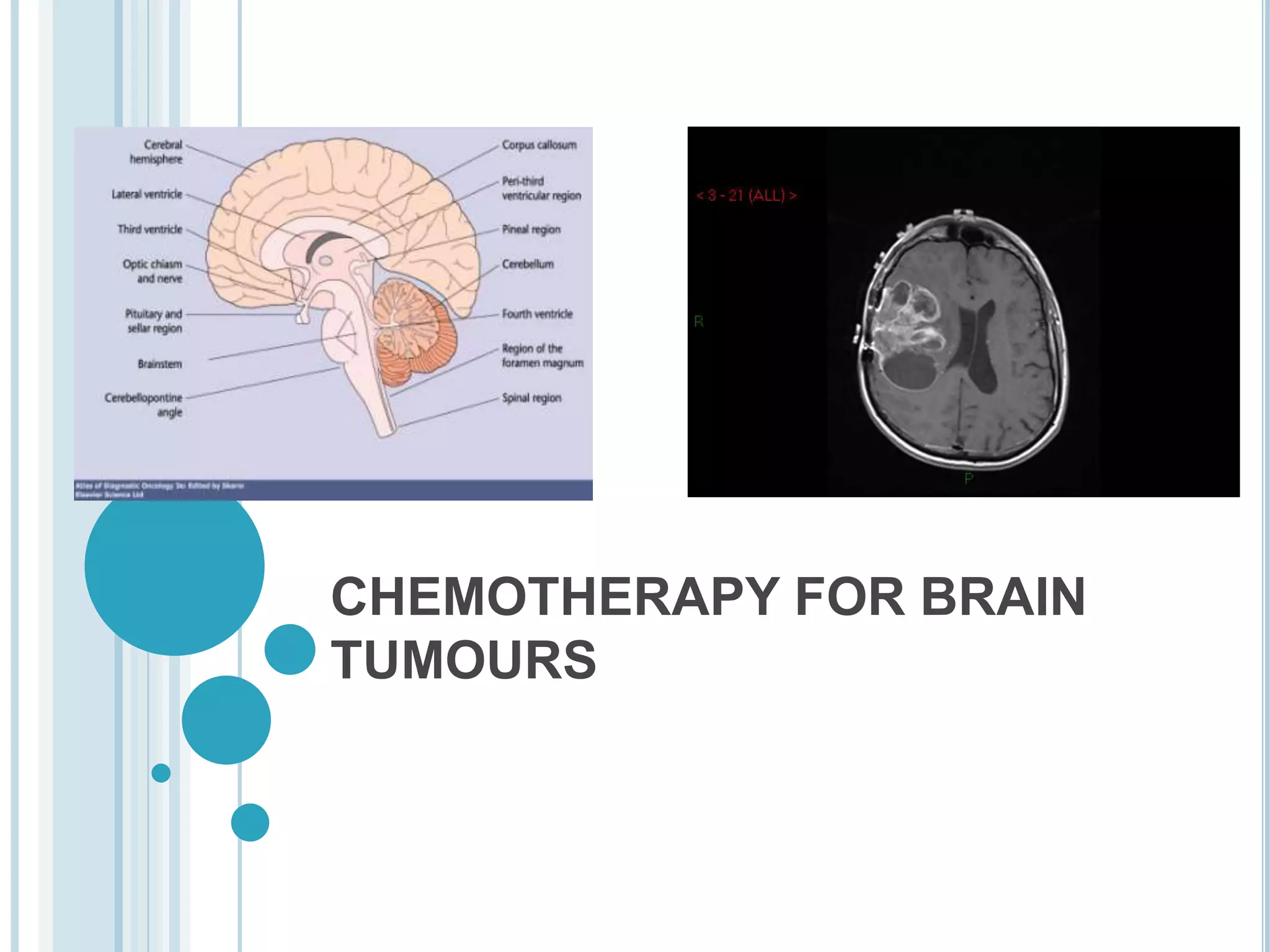 Chemotherapy for brain tumours | PPTX