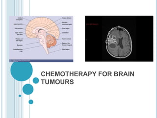 CHEMOTHERAPY FOR BRAIN
TUMOURS
ADD SOME
RELATED
PICTURE
 