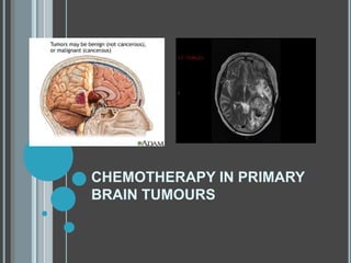 CHEMOTHERAPY IN PRIMARY
BRAIN TUMOURS
 