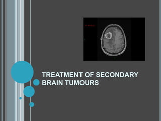 TREATMENT OF SECONDARY
BRAIN TUMOURS
 