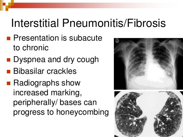 Chemotherapy Induced Lung Toxicity Dr Varun