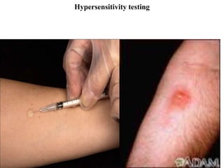 Hypersensitivity testing
 