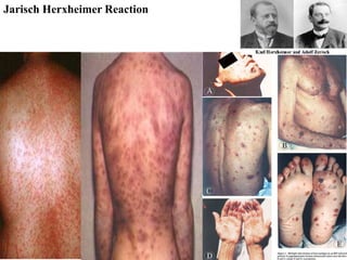 Jarisch Herxheimer Reaction
 
