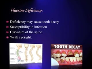  Deficiency may cause tooth decay
 Susceptibility to infection
 Curvature of the spine.
 Weak eyesight.
 