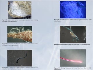 filament formation associated with the follicles. Microscopy revealed
                                                                                abnormalities of the follicular bulbs and the hair associated with these
                                                                                follicles that indicated abnormal functioning of follicular keratinocytes
                                                                                (Figures 4A-4D). Many follicles contained malformed bulbs with
                                                                                distorted shapes, and some follicles had two or more hairs branching
                                                                                from a single inner root sheath (Figure 4A). Filaments stemming from
                                                                                the bulb end were found in some follicles and these appeared as root-
                    )"*+,-(./''3#<.1+'-,'=!"#$%&'(#".&%9+'+<**-<%>$%/'0#-99&>'-*'>*$&>'&8<>"9&' (Figure 4B). Transparent filaments were observed that
                                                                                like growths
                    ,*-.'3"+&'4'54778'."/%$(0"9$-%:;                            stemmed from cells within the inner root sheath (Figure 4C). On some
                                                                                hairs red or blue colored filaments branched from the shaft (Figure
                                                                                4D). Many hairs were flattened or tape-like on cross-section rather
                                                                                than concentric. These )"*+,-(.)''?#<$+='C<-*&+0&%0&'-,'()&*+'<%>&*'DE'#$/=9$%/',*-.'3"+&'4'54778'
                                                                                                          hairs were similar in appearance to Morgellons
)"*+,-( .!'( 1!"#$%&' ()&*+' ,-*.$%/' ."0*-+0-1$0' ."++&+' $%' (%/&*' 2&))$%/'
,*-.'3"+&'4'5678'."/%$(0"9$-%:;
                                                                                filaments.                ."/%$(0"9$-%:;

                                                                                 BDD Microscopic observations
                                                                                      Biopsies from late proliferative stage BDD lesions were examined
                                                                                 microscopically for comparison (Figures 5A-5D). Although the scale
                                                                                 of filaments was much larger, the BDD filaments (roughly ten times




                   )"*+,-(.0''?#<&'(#".&%9'2$9=')<#)@#$A&'&%>'567'B.'>$".&9&*:'+$.$#"*'9-'"'="$*'
                   ,-##$0#&',*-.'3"+&'4'54778'."/%$(0"9$-%:;


                was not fluorescent nor was normal skin. Color intensity and hue of
)"*+,-(./''3#<.1+'-,'=!"#$%&'(#".&%9+'+<**-<%>$%/'0#-99&>'-*'>*$&>'&8<>"9&'
                the red and blue filaments was influenced by the
,*-.'3"+&'4'54778'."/%$(0"9$-%:;                                    color spectrum of                      )"*+,-(.1''F*$>&+0&%0&'-,'"'/*&&%'()&*',*-.'3"+&'4'54778'."/%$(0"9$-%:;
                the illuminating light. This property and the presence of iridescence
                suggests that a structural component is involved in the unusual colors
                seen in Morgellons fibers.
                                                                                    )"*+,-(.)''?#<$+='C<-*&+0&%0&'-,'()&*+'<%>&*'DE'#$/=9$%/',*-.'3"+&'4'54778'
                                                                                    ."/%$(0"9$-%:;
                    Case 2: Microscopic examination of scab material revealed scab
                detritus imbedded with long filaments of various colors (Figures 3A-
                3D). Hyaline, red, blue, and light purple fibers were observed (10-40
                µm diameter) (Figure 3A, Figure 3B). One sample revealed fibers
                tangled around a hair and these fibers may have been associated
                with the hair follicle (Figure 3C). Smaller, pale purple fibers (10 µm
                diameter) appeared to form a mesh around the follicle. Some samples
                revealed fibers that lay beneath or penetrated dermal tissue Figure 3D.
                       Case 3: Microscopic examination was performed with particular
)"*+,-(.0''?#<&'(#".&%9'2$9=')<#)@#$A&'&%>'567'B.'>$".&9&*:'+$.$#"*'9-'"'="$*'                             )"*+,-( .2'' G9*$A$%/' $*$>&+0&%0&' -,' "' *&>' ()&*' ,*-.' 3"+&' 4' 54778'
,-##$0#&',*-.'3"+&'4'54778'."/%$(0"9$-%:; follicles, as the patient had reported unusual
                  attention to hair                                                                        ."/%$(0"9$-%:;
 