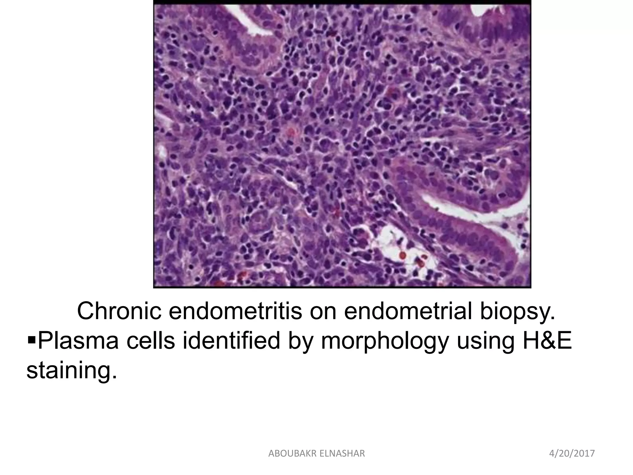 Chronic endometritis on endometrial biopsy.
Plasma cells identified by morphology using H&E
staining.
4/20/2017ABOUBAKR ELNASHAR
 