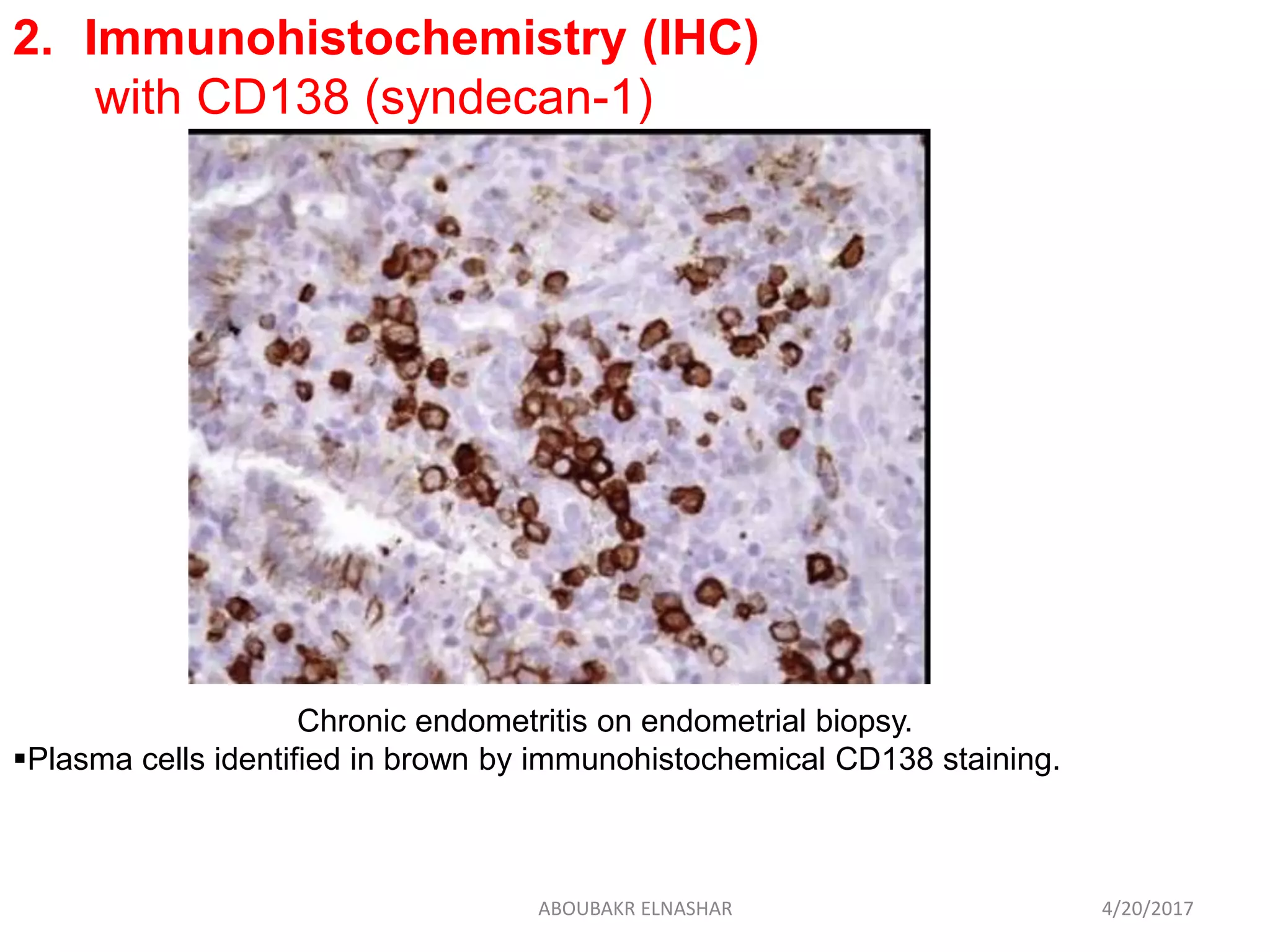 2. Immunohistochemistry (IHC)
with CD138 (syndecan-1)
Chronic endometritis on endometrial biopsy.
Plasma cells identified in brown by immunohistochemical CD138 staining.
4/20/2017ABOUBAKR ELNASHAR
 