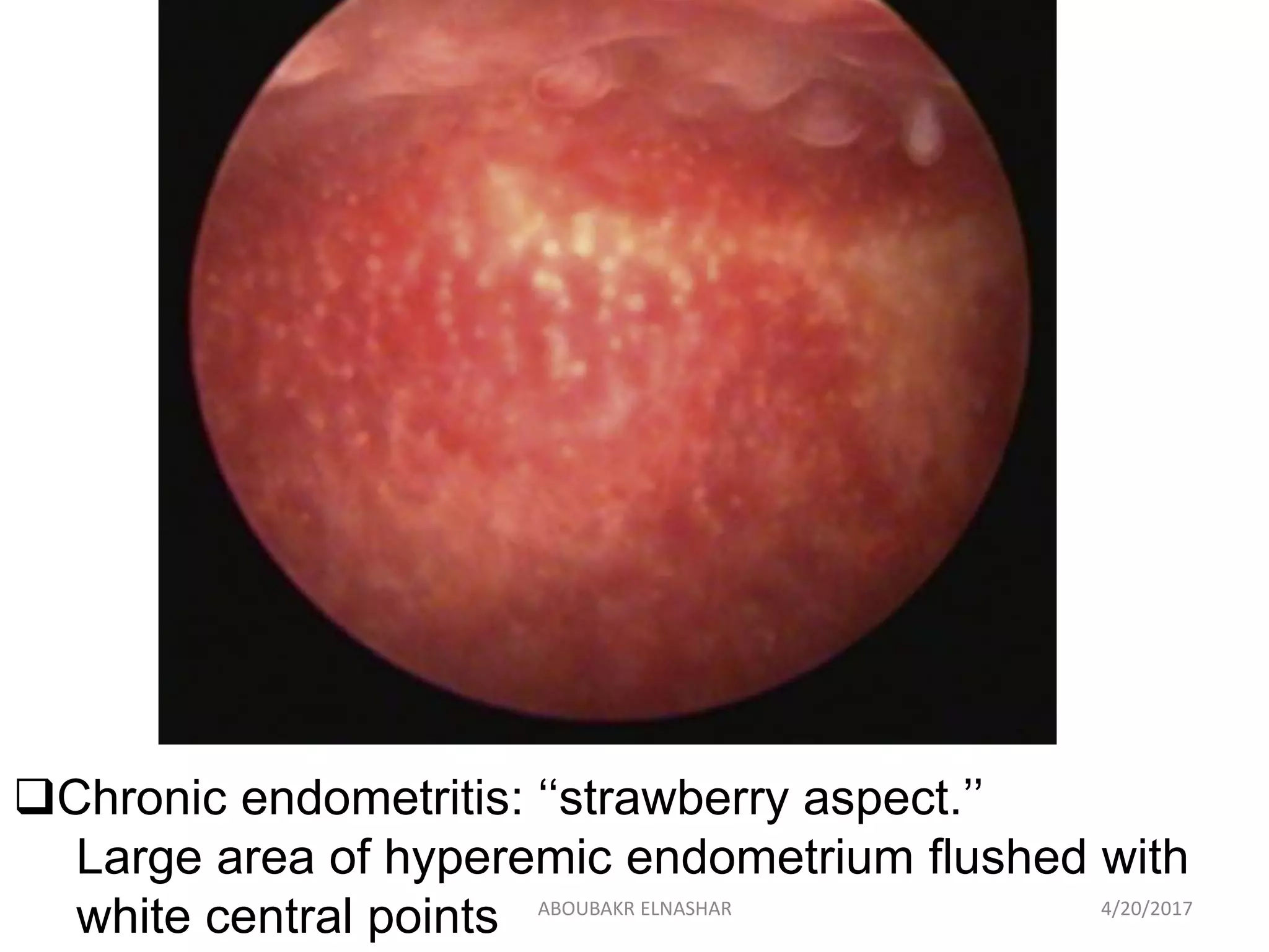 Chronic endometritis: ‘‘strawberry aspect.’’
Large area of hyperemic endometrium flushed with
white central points 4/20/2017ABOUBAKR ELNASHAR
 