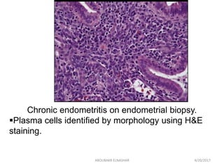 Chronic Endometritis  in   Repeated miscarriage  and  Repeated implantation failure Slide 17
