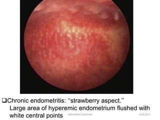 Chronic Endometritis  in   Repeated miscarriage  and  Repeated implantation failure Slide 22