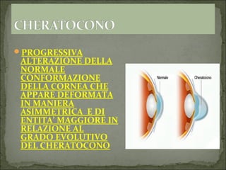 Cheratocono Eziopatogenesi E Diagnosi PPT