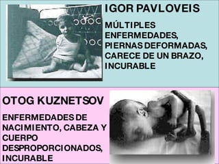 IGOR PAVLOVEIS   MÚLTIPLES ENFERMEDADES, PIERNAS DEFORMADAS, CARECE DE UN BRAZO, INCURABLE OTOG KUZNETSOV ENFERMEDADES DE NACIMIENTO, CABEZA Y CUERPO DESPROPORCIONADOS, INCURABLE 