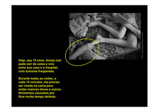 Foto: Greenpeace/Robert Knoth
Hoje, aos 15 anos, Annya mal
pode sair da cama e vive
entre sua casa e o hospital,
com tumores freqüentes.

Durante todas as noites, a
cada 15 minutos, ela precisa
ser virada na cama para
evitar maiores dores e outros
ferimentos causados por
ficar muito tempo deitada.
 