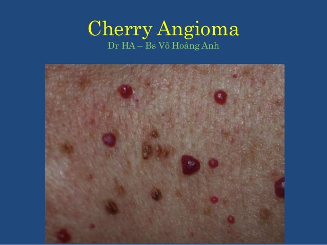 Cherry Angioma
Dr HA – Bs Võ Hoàng Anh
 
