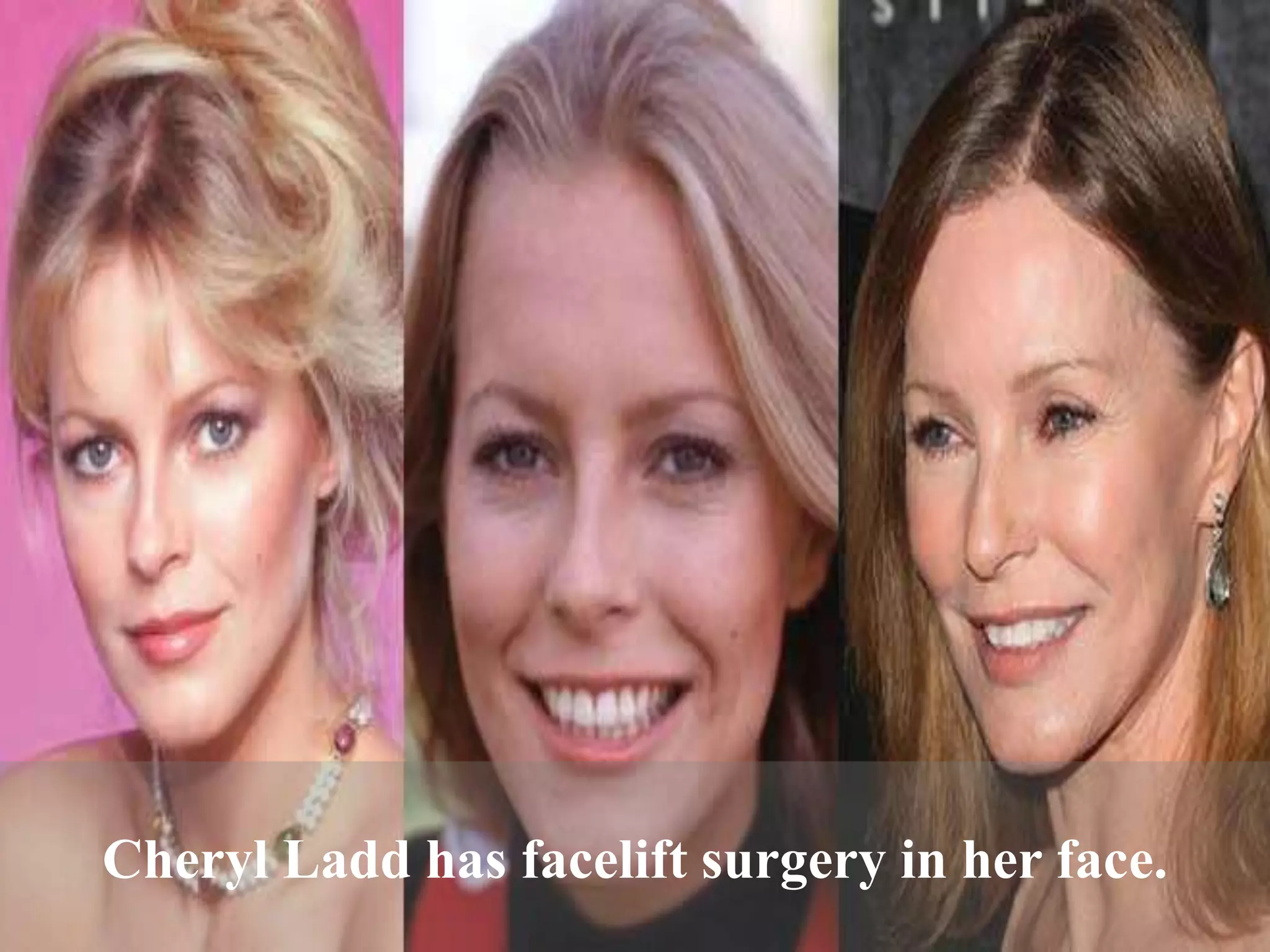 Cheryl ladd plastic surgery | PPTX