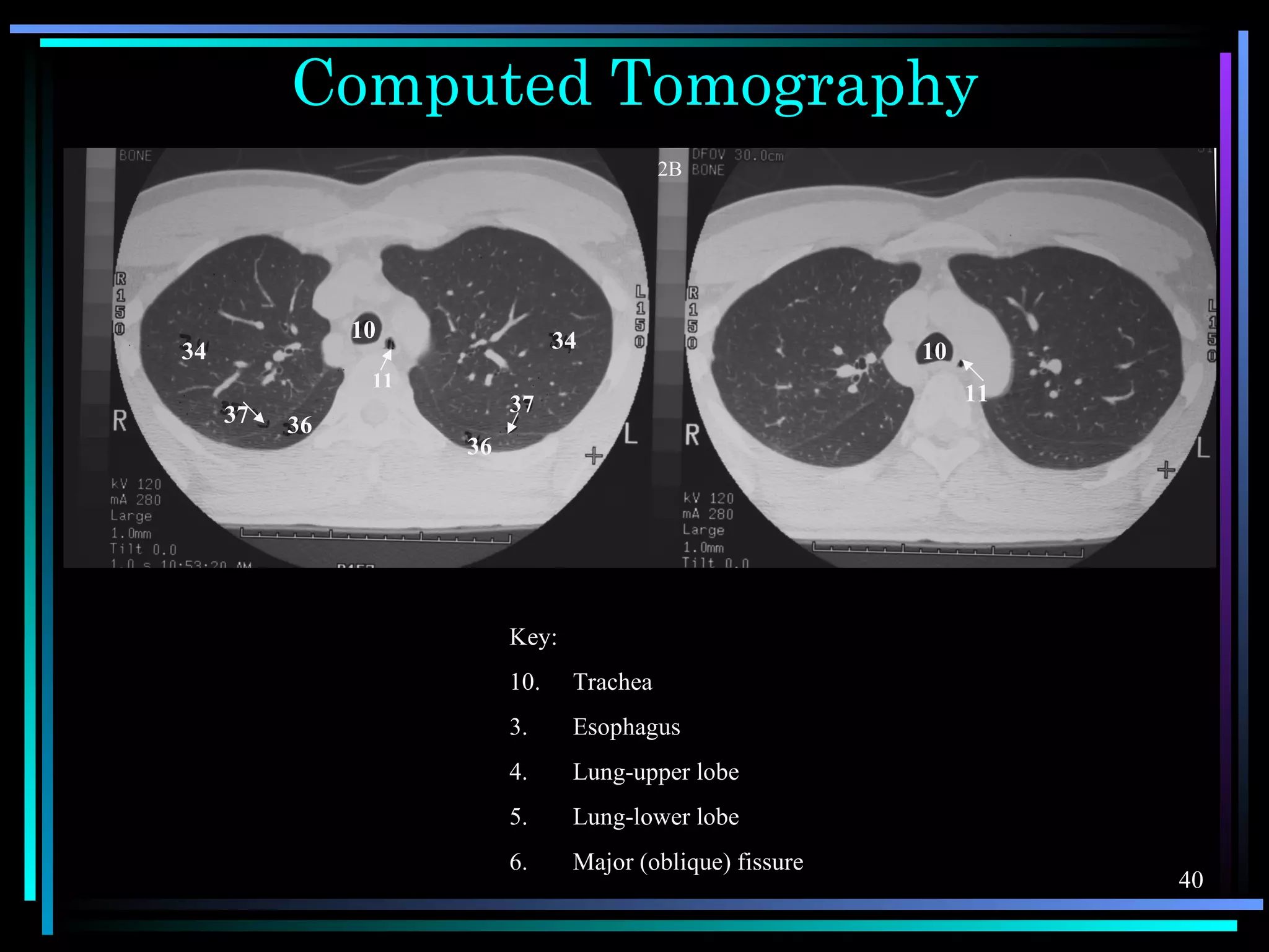 Chest X-ray anatomy | PPS