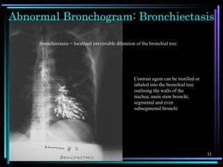 Chest X-ray anatomy | PPS