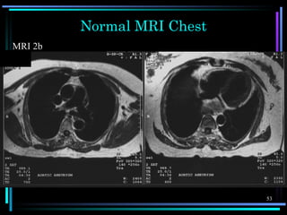 Chest X-ray anatomy | PPS