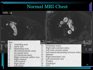 Chest X-ray anatomy | PPS