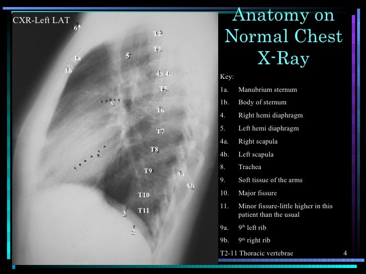 Chest X-ray anatomy