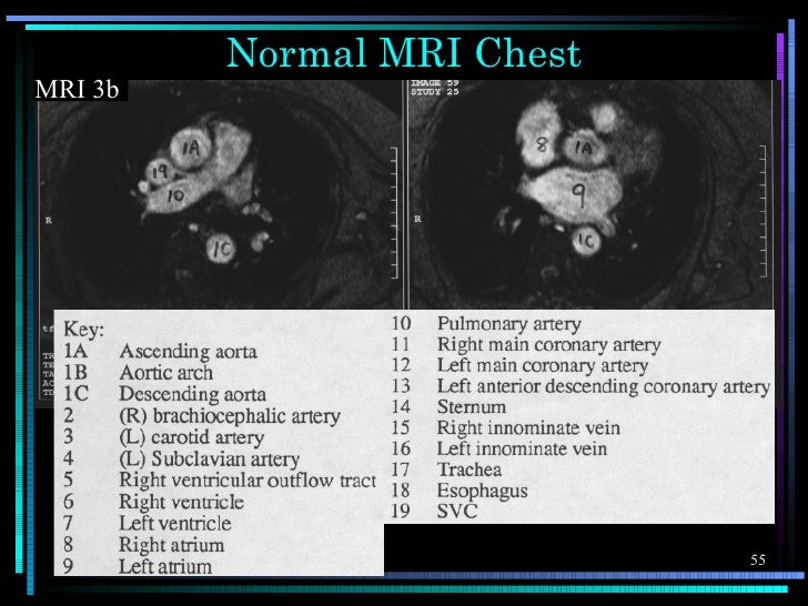 Chest Xray anatomy