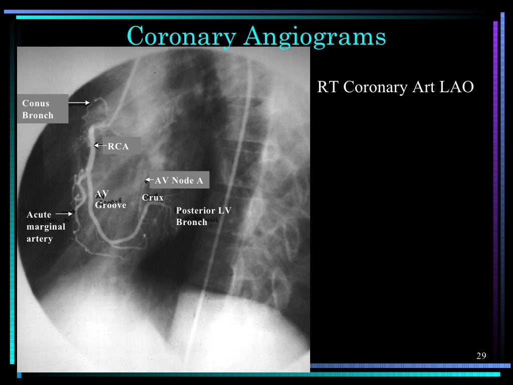 Chest X-ray anatomy
