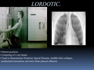 Lordotic View chest examination.pptx.pdf
