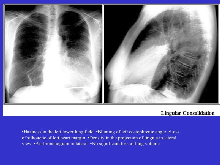 chest-lungs-3