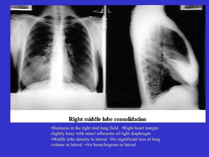 Chest xrays pneumonias
