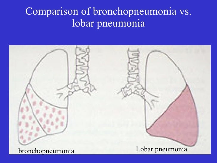 Chest xrays pneumonias